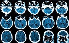 Investigadores descubren el secreto de la «inmortalidad» del cáncer cerebral