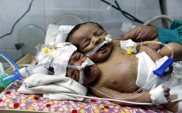 Médicos piden ayuda para trasladar a dos siameses recién nacidos en Yemen