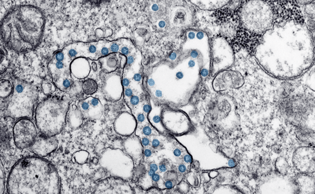 La 'misteriosa' proliferación de trombos en los enfermos de Covid-19