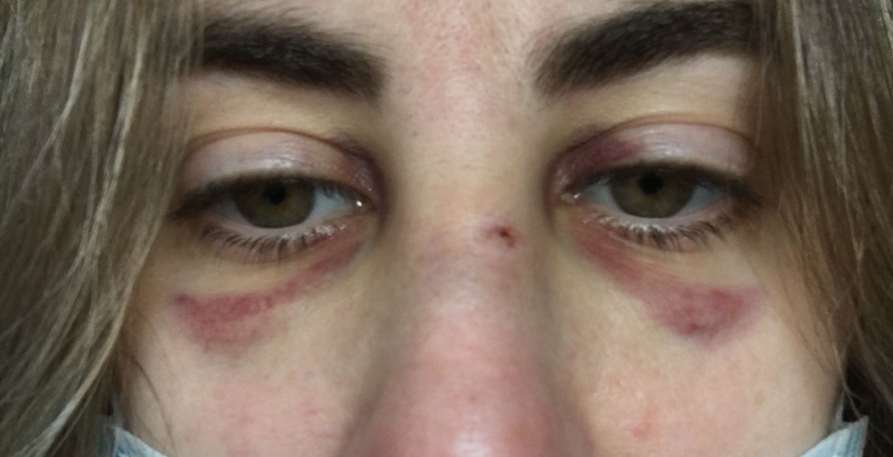 Un conductor arremete tres veces contra la conductora de un patinete y le produce una fractura en la nariz