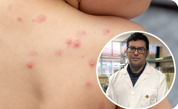 El virólogo leonés Estanislao Nistal advierte que la viruela del mono es menos grave que el covid, «pero debe vigilarse»