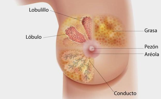 ¿Qué es el cáncer de mama?
