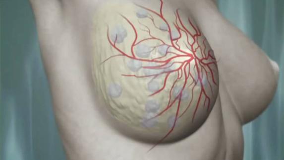 «La autoexploración no sustituye a la mamografía»