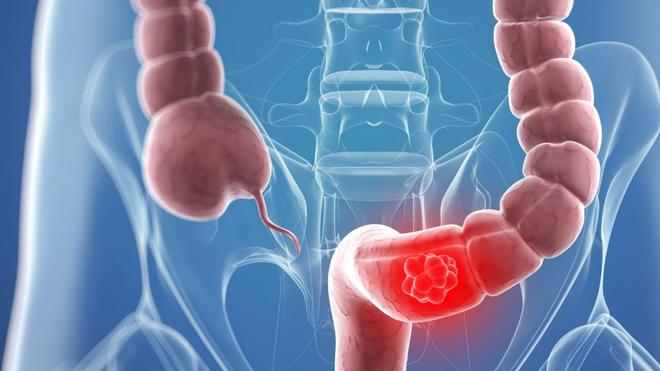 El temido cáncer de colon
